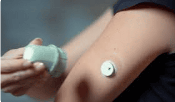 Sensor de monitoreo continuo de glucosa aplicado al brazo
